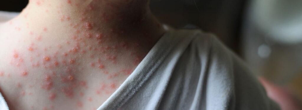 La viruela del mono · Blog · Policías por la Libertad